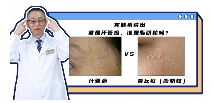 你以为的脂肪粒其实是肿瘤,脂肪粒会转变成癌吗