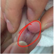 脑瘫踝关节术后康复,脑瘫完全康复