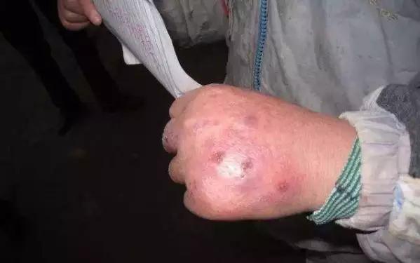 民间治冻疮的最好方法,老中医妙方萝卜加陈皮治冻疮