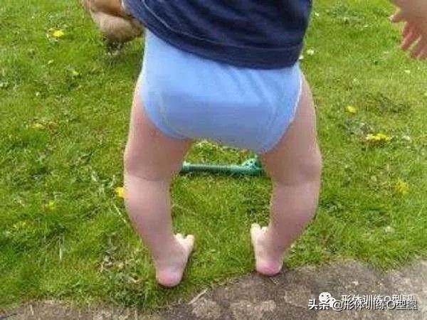 o型腿罗圈腿,后期形成的罗圈腿怎么自我矫正