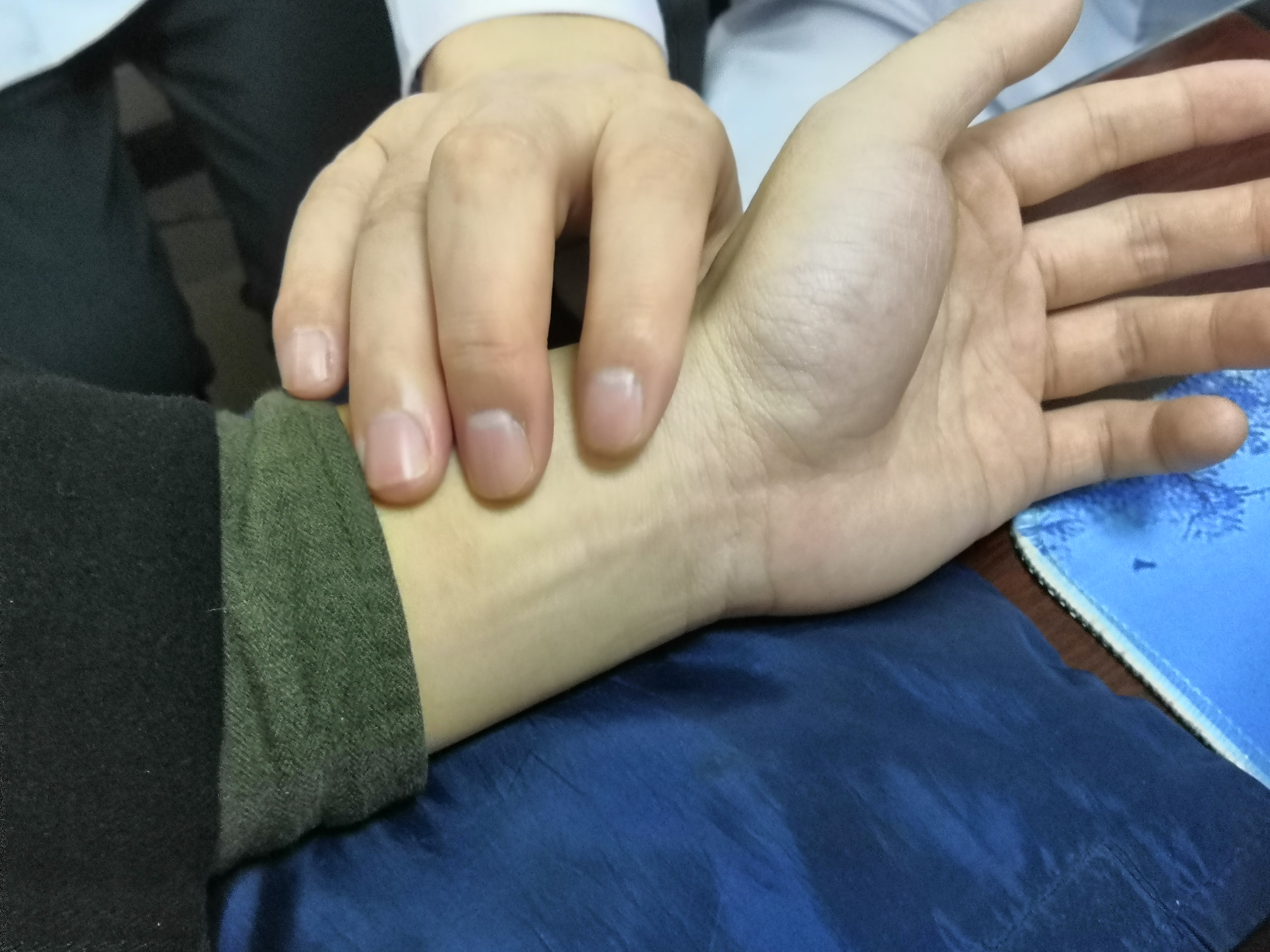 前列腺钙化导致尿频怎么办,前列腺增生钙化排尿困难如何解决