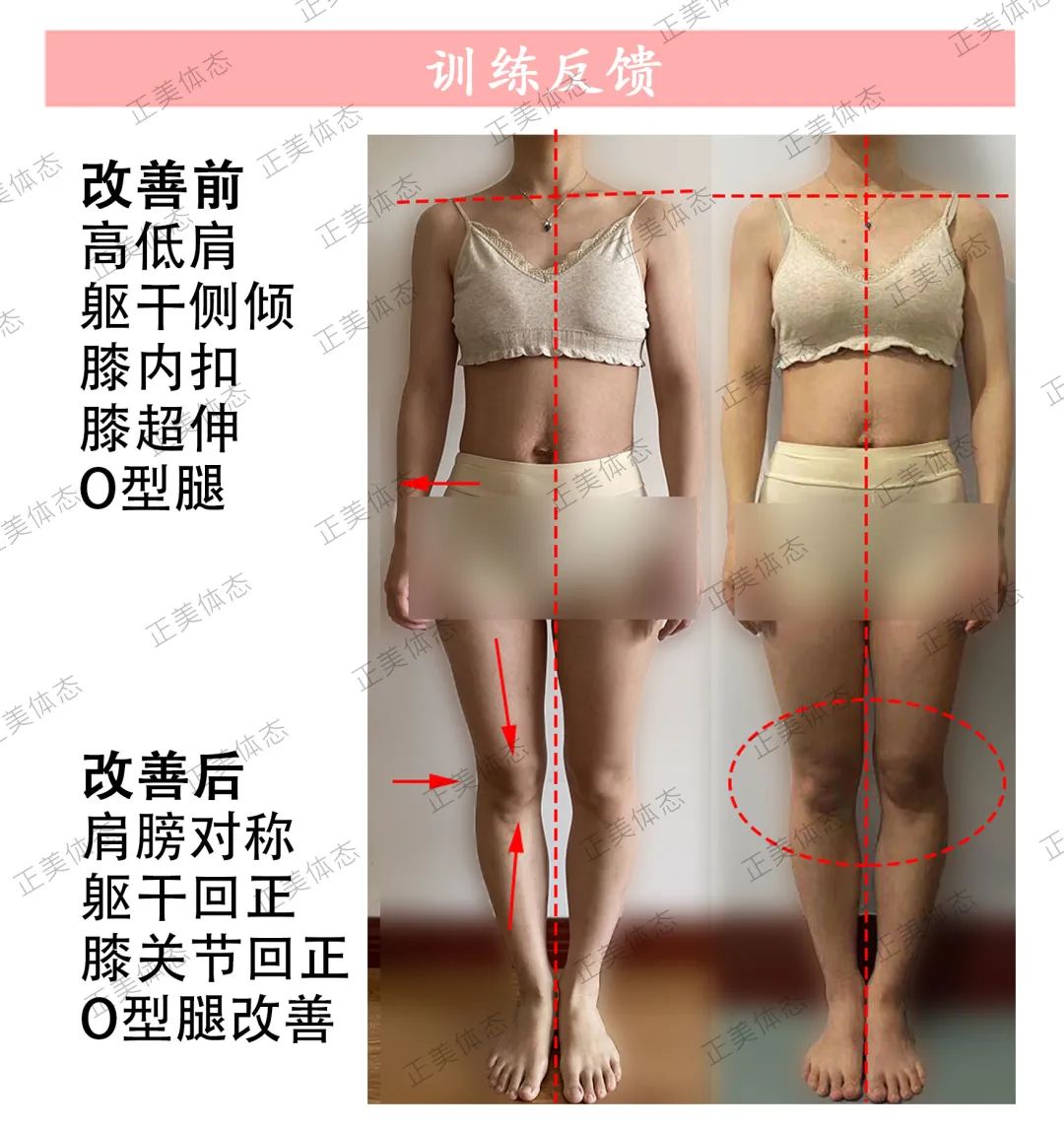 腿不直怎么修饰腿型,塑造腿型