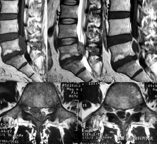 腰椎间盘突出的影像学诊断及治疗,腰椎间盘突出影像学课件