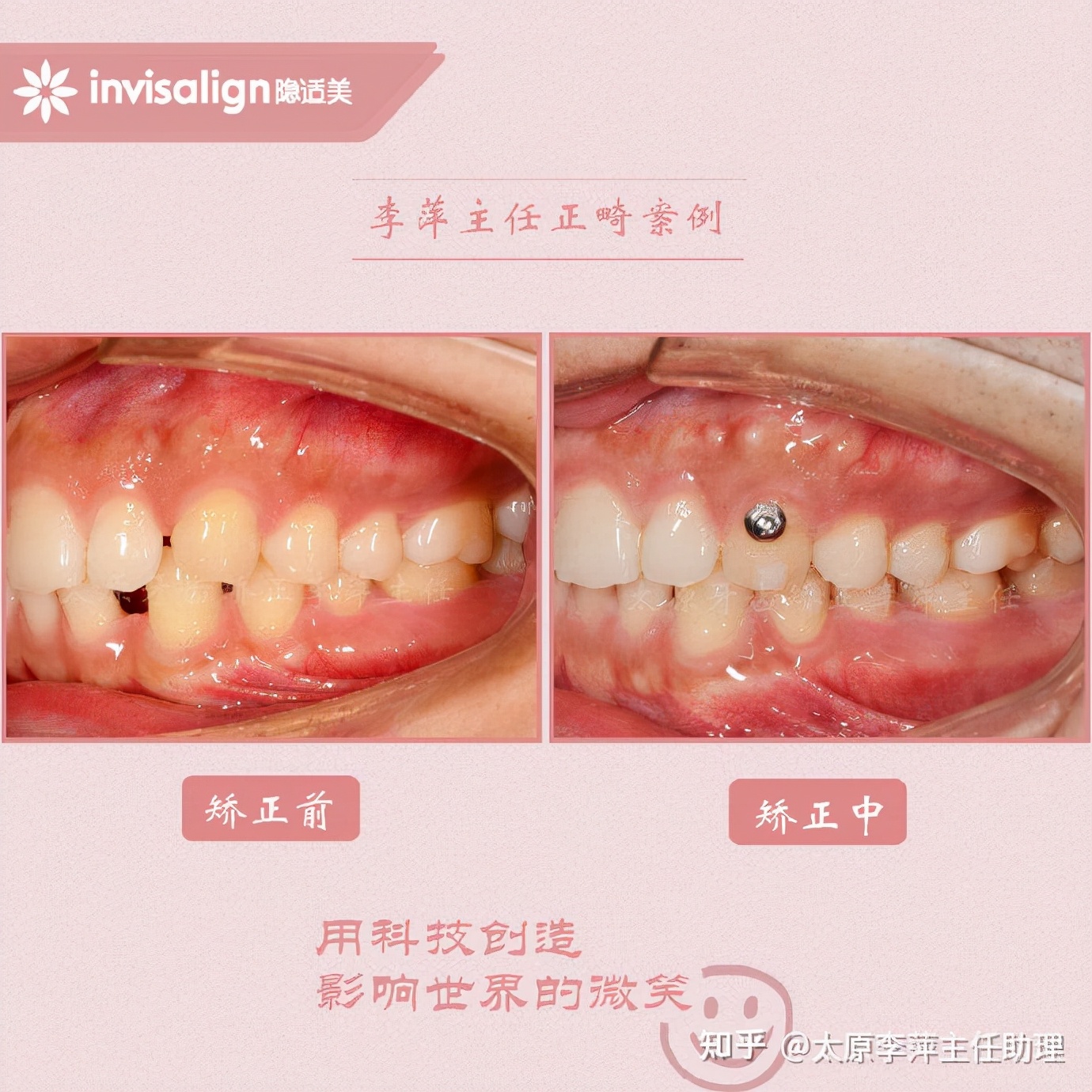 重度拥挤矫正牙齿适合隐形牙套吗,广州成人牙齿矫正推荐隐形牙套