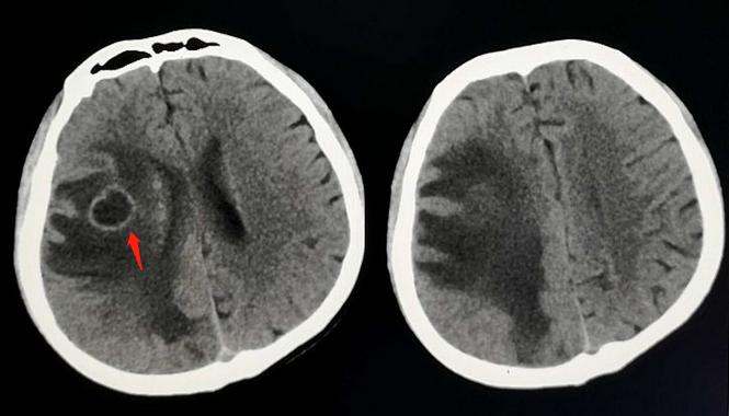 小伙在网吧呆了十年肺结核,父母离异的网吧小伙