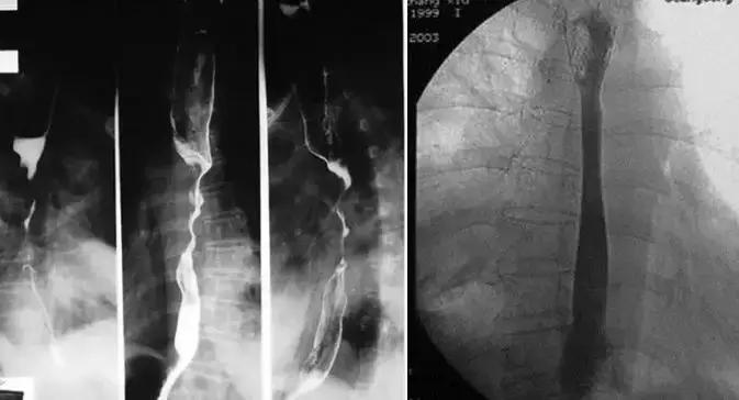 晚期癌症怎么能治,治疗癌症肿瘤的方式都有哪些