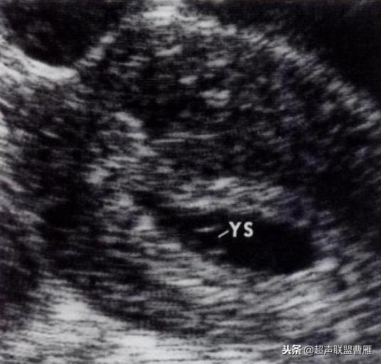 3毫米卵黄囊未见胎芽正常么,40多天的卵黄囊