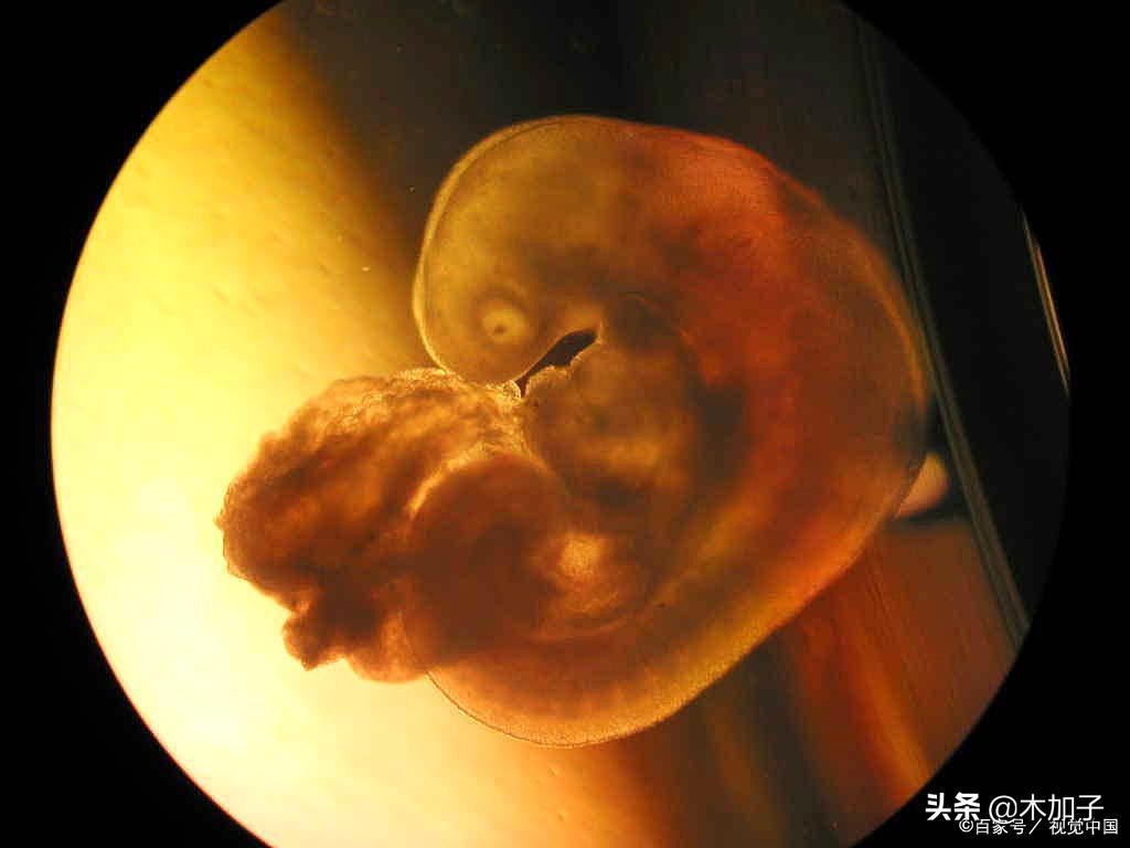 胎停两次第三次正常的可能性大吗,两次胎停后再次备孕需要检查什么