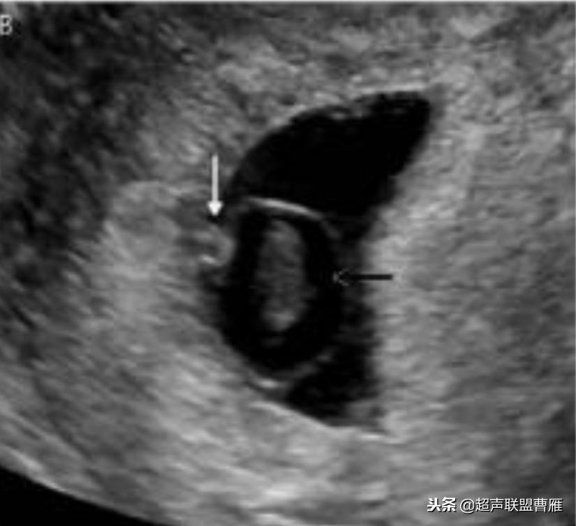 3毫米卵黄囊未见胎芽正常么,40多天的卵黄囊