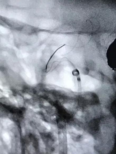 山东大学齐鲁医院王东海教授团队成功治疗多发性动脉瘤