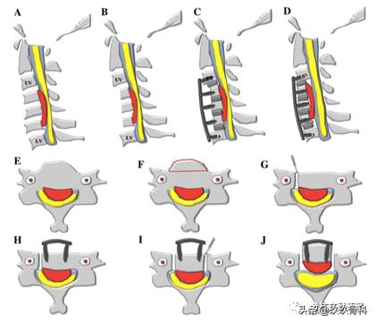 acaf手术适应脊髓型颈椎病吗,acaf术后康复方法