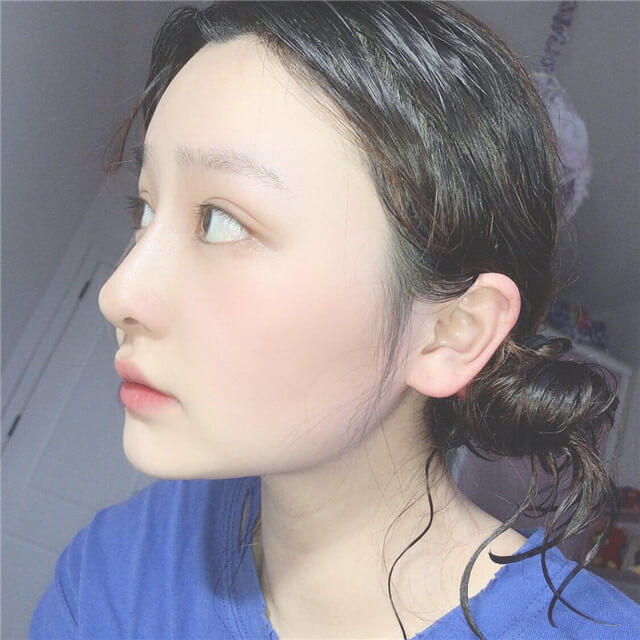 额头长粉刺闭口的正确消除方法,怎么用闭口针去闭口粉刺