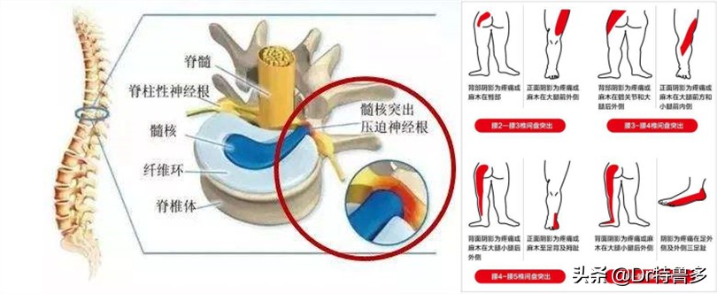 大腿内侧疼是压迫哪根神经引起的,大腿内侧神经疼要警惕