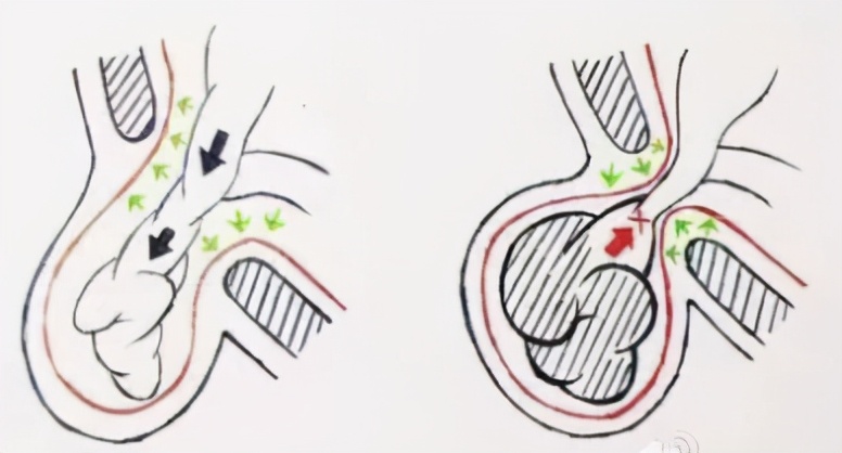 肝移植后十大并发症的观察,肝移植术后复查注意事项