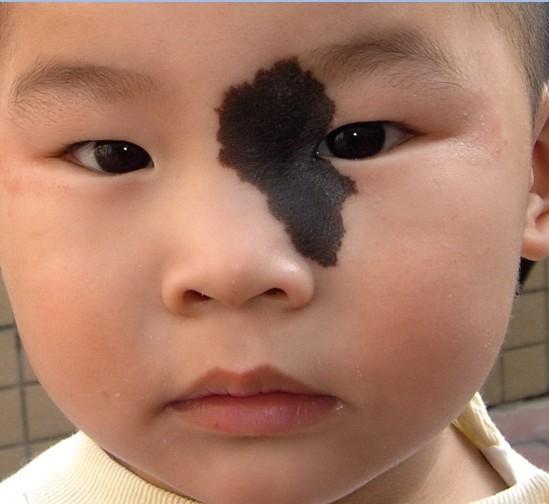 去除黑毛痣最有效方法,黑毛痣去除有几种办法