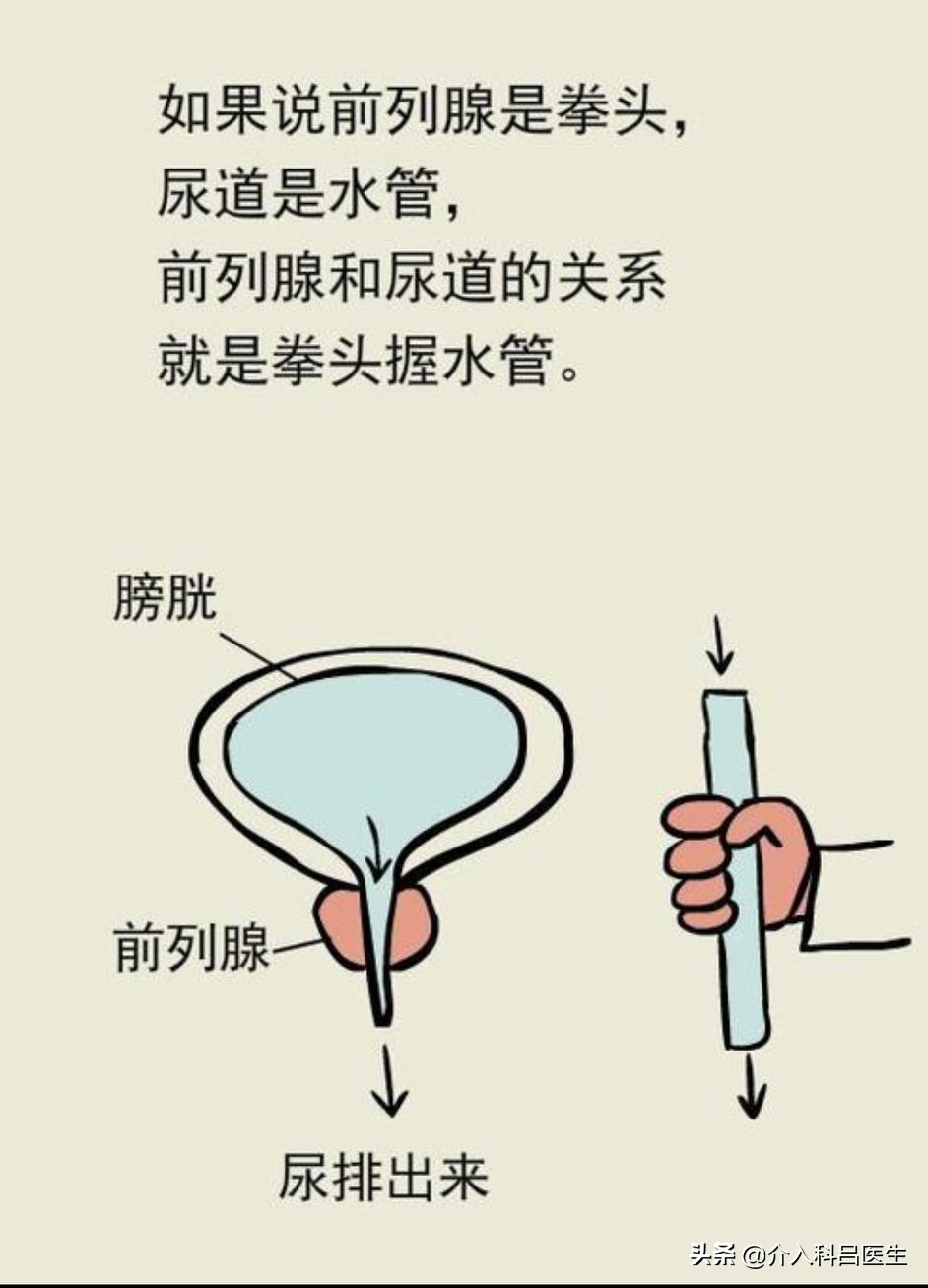 前列腺增生尿频夜尿多吃中成药,前列腺增生尿频尿急漏尿如何治疗