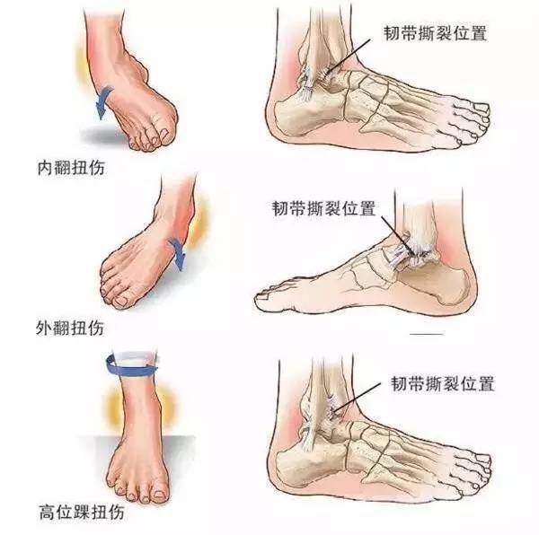 踝关节扭伤陈年旧伤如何康复,踝关节扭伤后下楼梯怎么康复