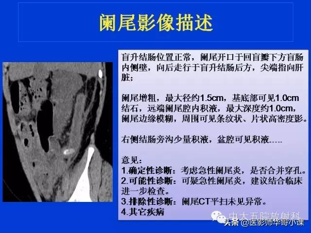 阑尾炎课件,阑尾炎的超声课件