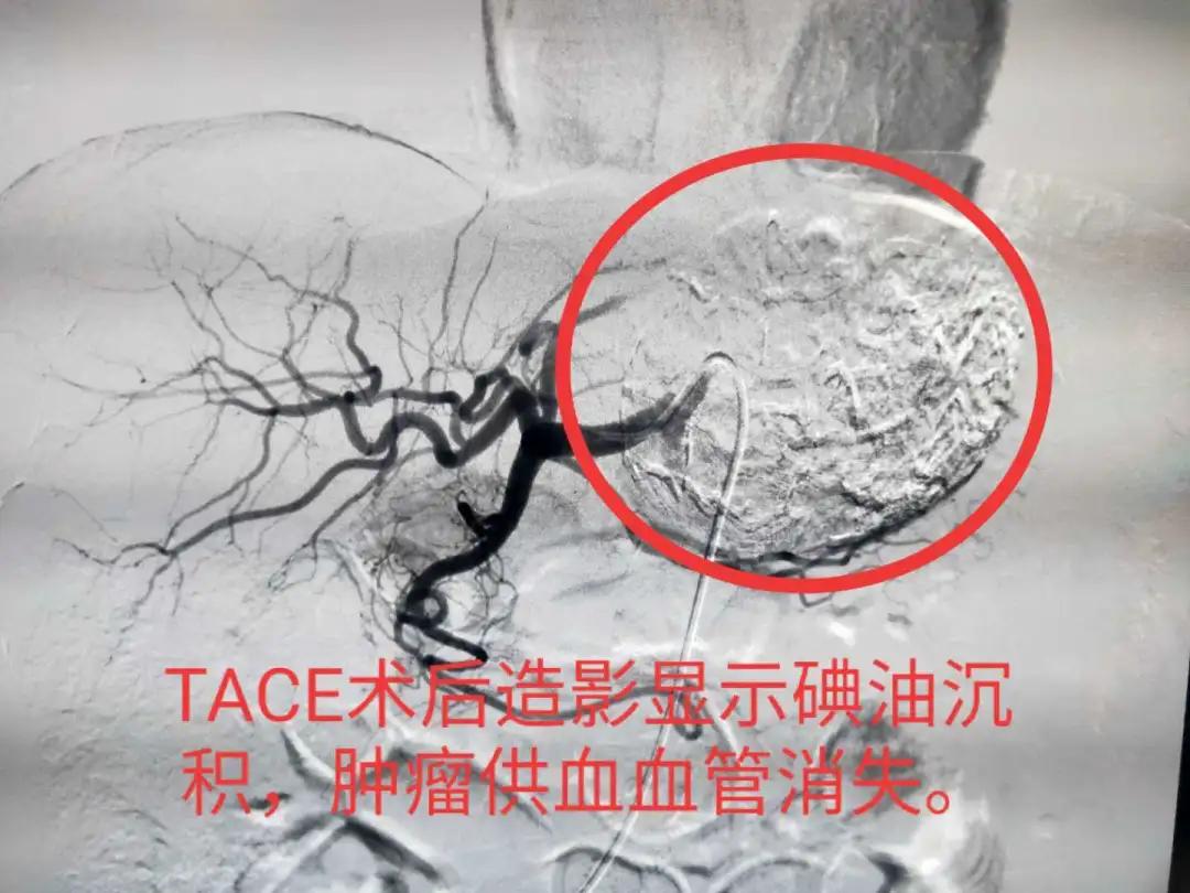 恶性肿瘤介入治疗是什么意思,肿瘤怎么致死
