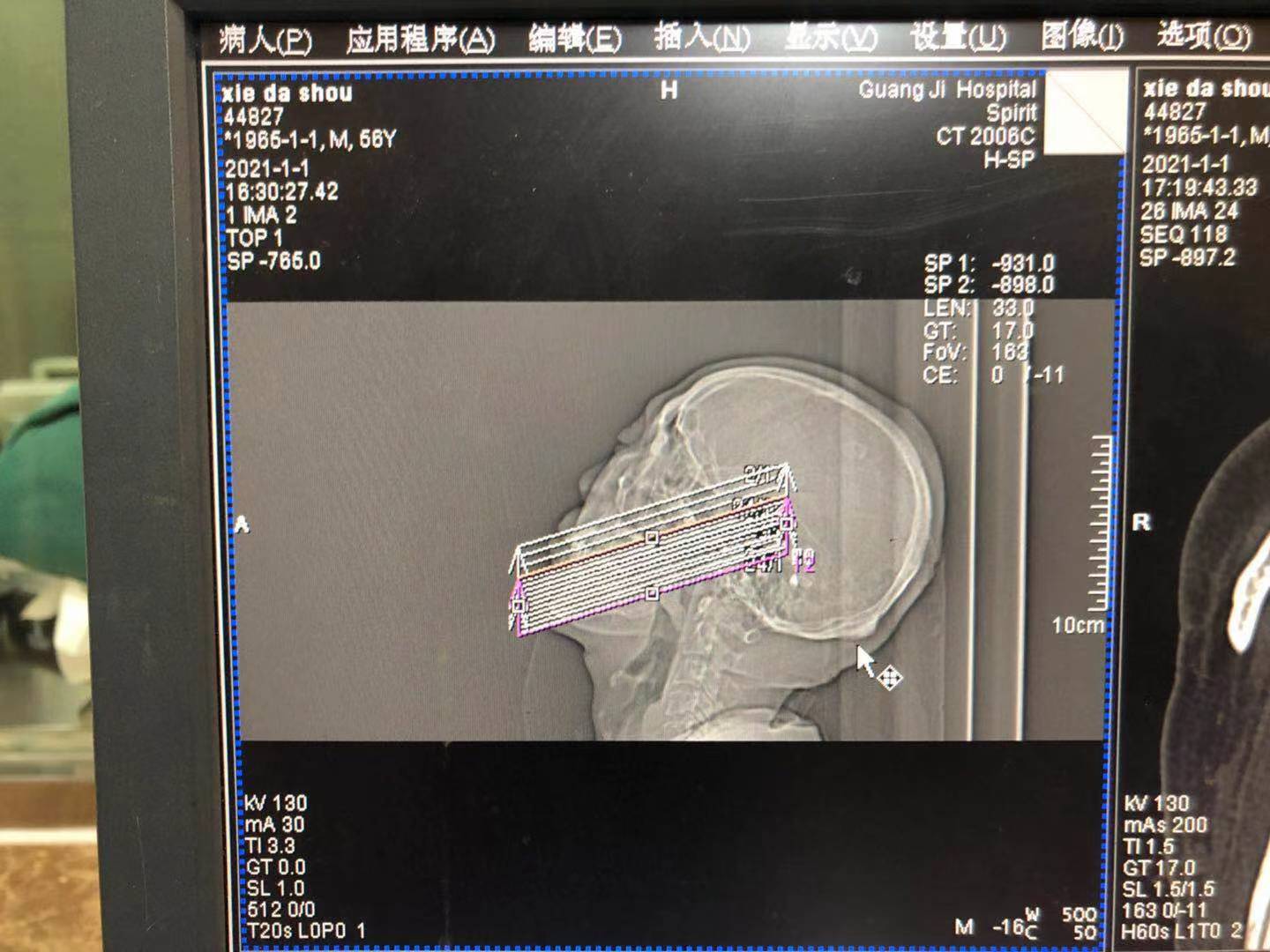 三叉神经慢性疼痛,治好了几十年的三叉神经痛