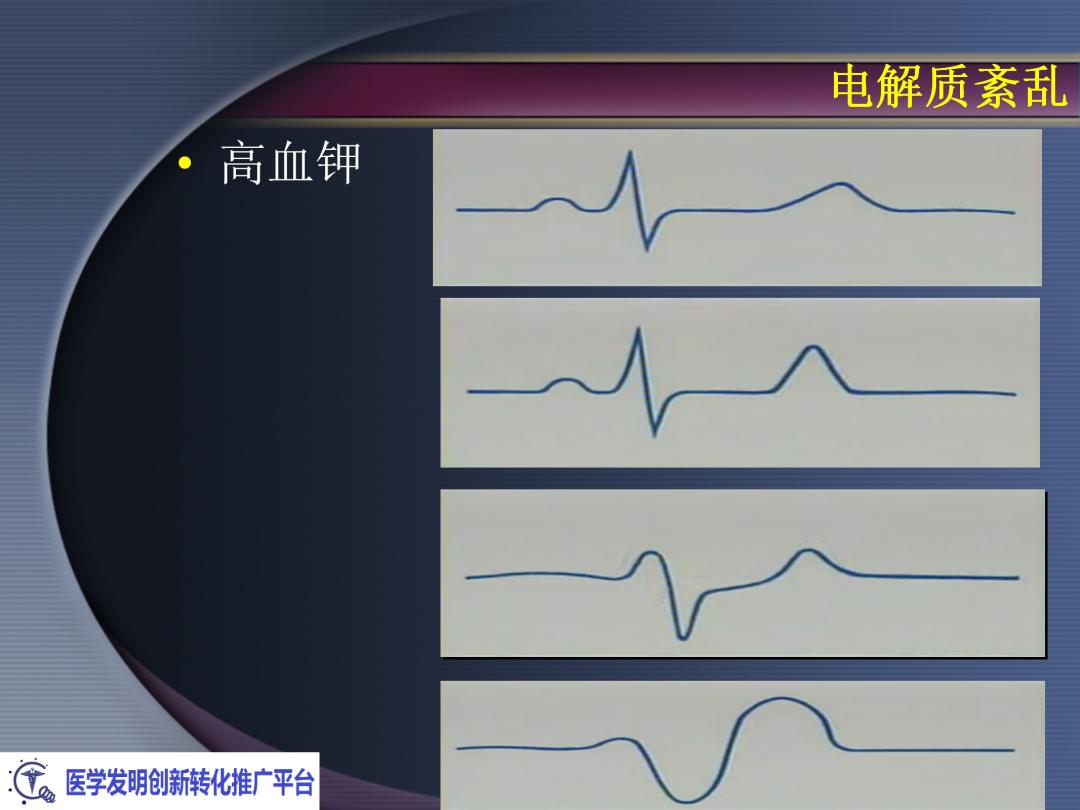 麻醉手术常见心律失常处理,麻醉引起心脏骤停原因