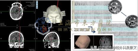 癫痫热凝术复发率高吗,难治癫痫可以用新药控制住吗