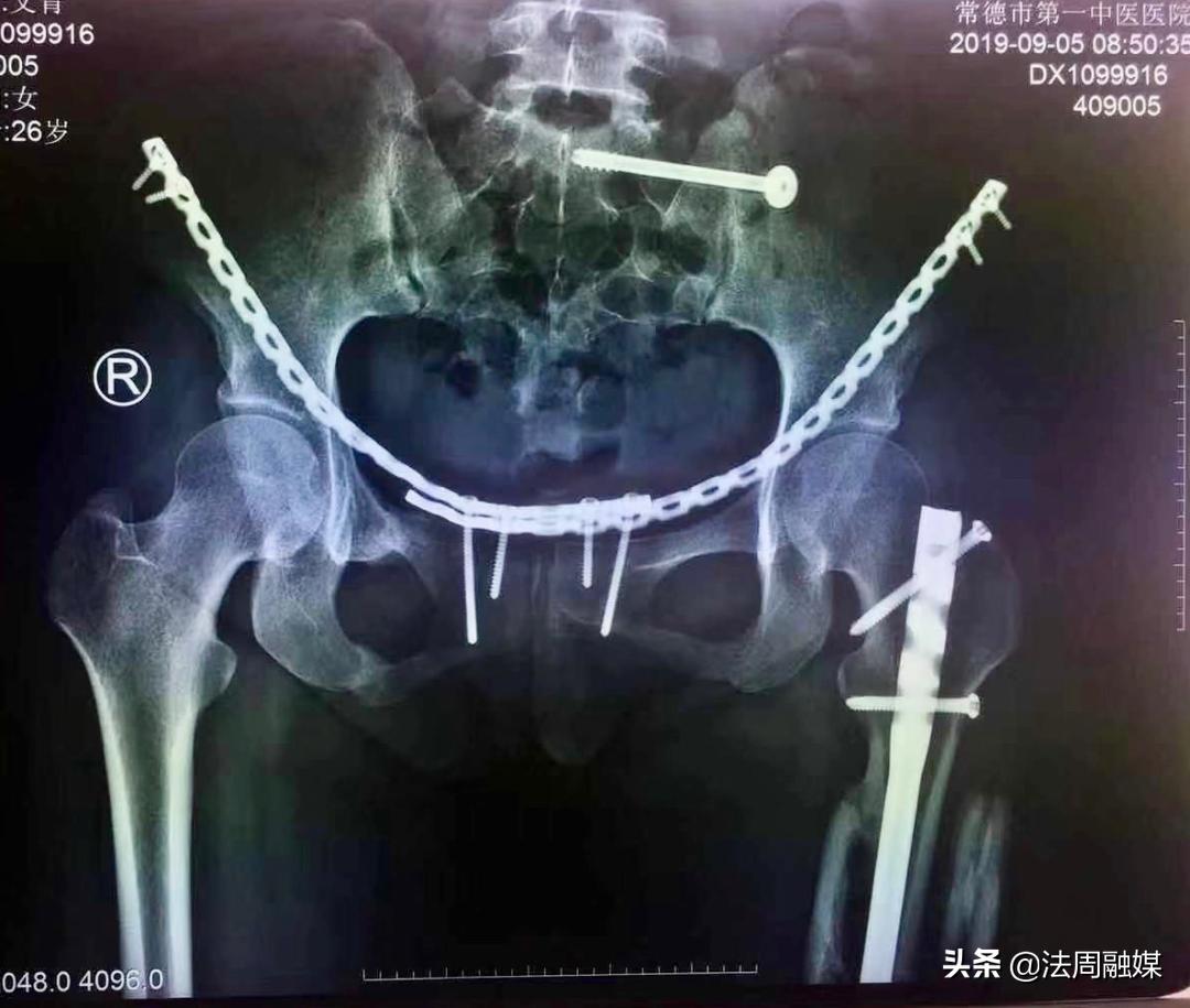 交通事故小腿胫骨骨折做手术,常德市第一中医医院骨伤科