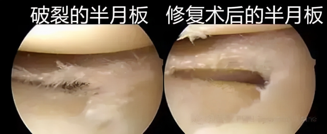 微创手术能治好骨性关节炎吗,膝盖关节镜微创手术要脱衣服吗