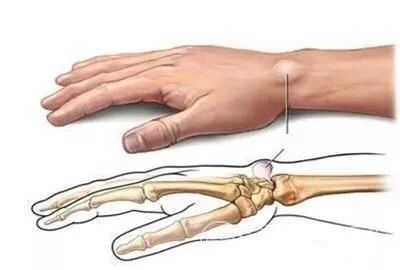 腱鞘炎手指关节弹响,手指腱鞘炎还能弹琴吗