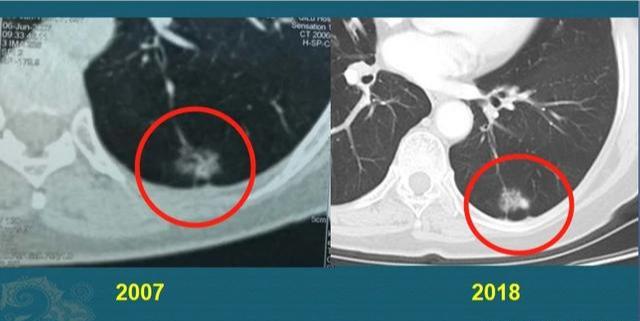 大部分癌症都能早期发现吧,所有癌症都能通过验血发现吗