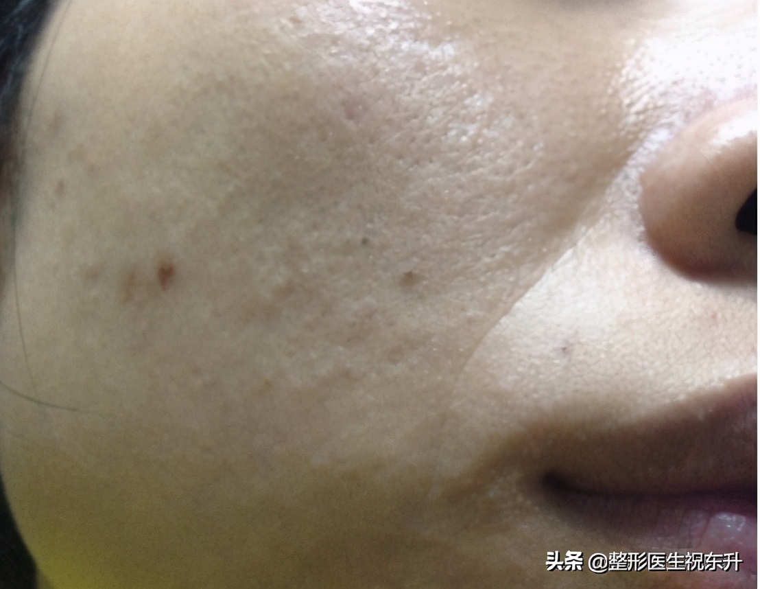 自体脂肪填充法令纹亲身经历,法令纹是不是出现了才能填充