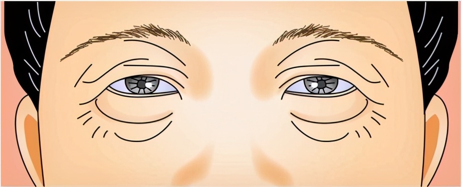 什么原因导致双眼皮不明显,双眼皮增生了会自己消失吗