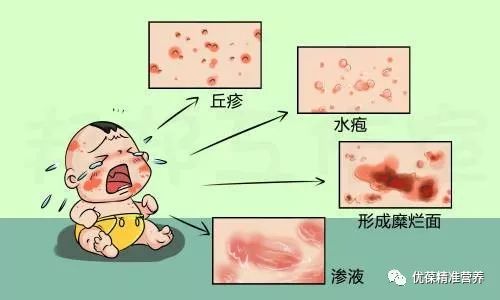 母婴湿疹是什么原因引起的,母婴外阴湿疹怎么办