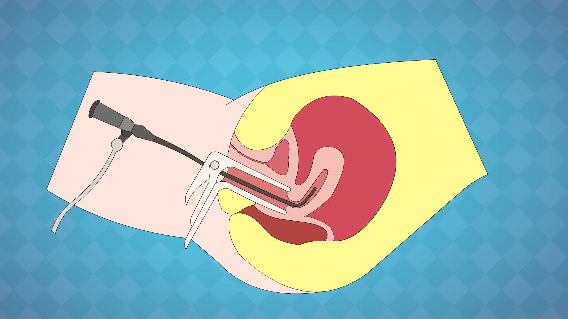 女性人工流产后会复发吗,女人人工流产会引起消瘦吗