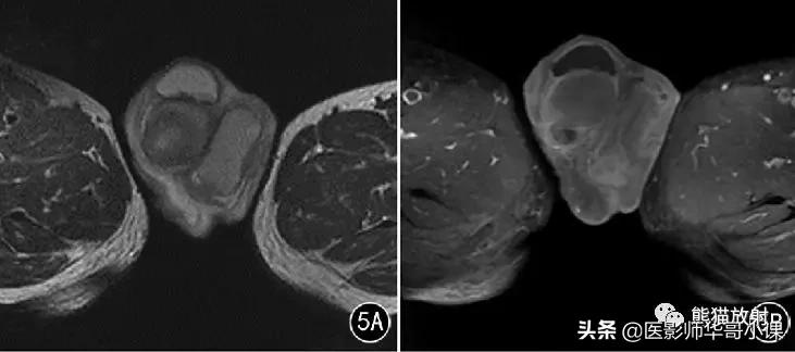 [精品课件]畸胎瘤及精原细胞瘤（*丸睾**肿瘤及肿瘤样变CT及MR表现）