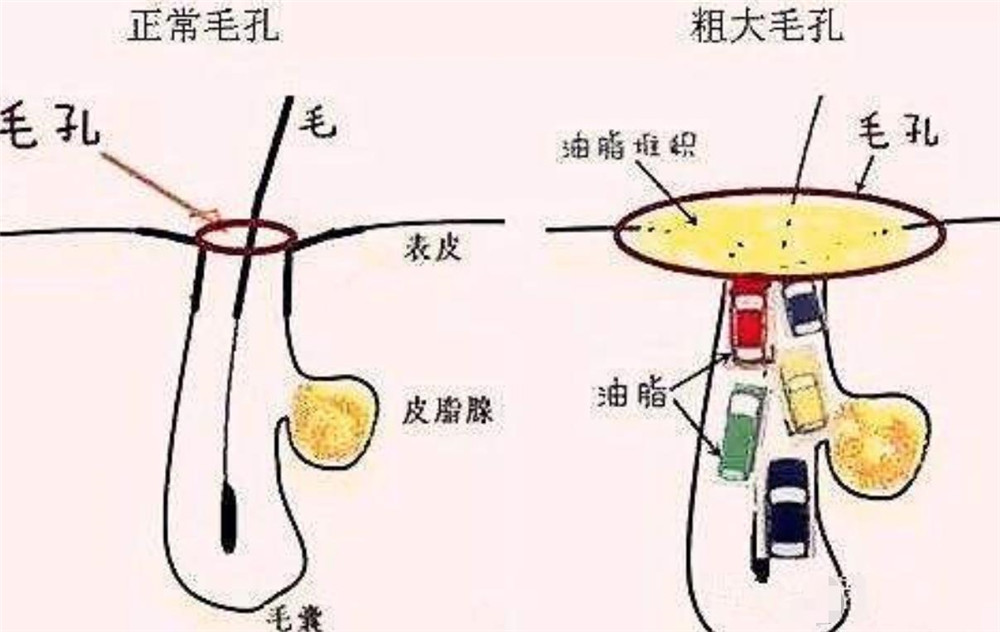 鼻子毛孔粗大如何改善学生党,鼻子毛孔粗大最好的解决方法