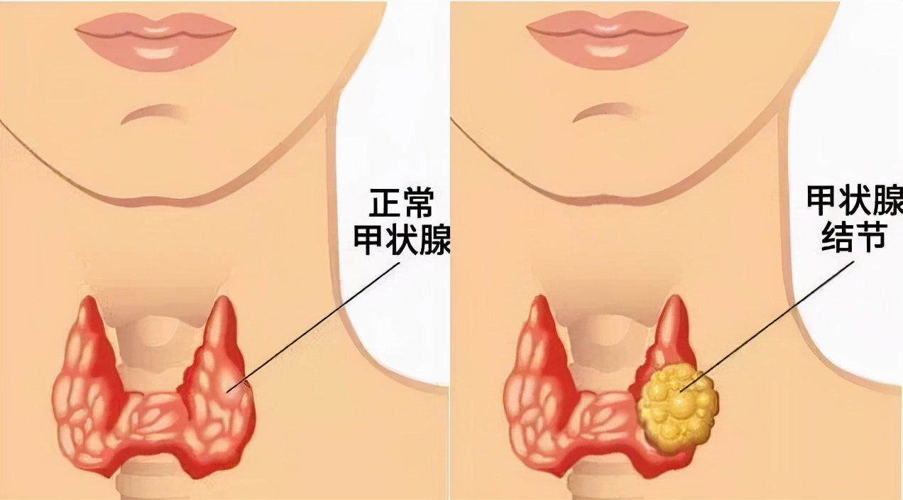 中日友好医院微波消融甲状腺结节,微波消融术适用于甲状腺微小癌吗