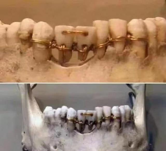 拔牙靠理发师，太阳王的黑历史