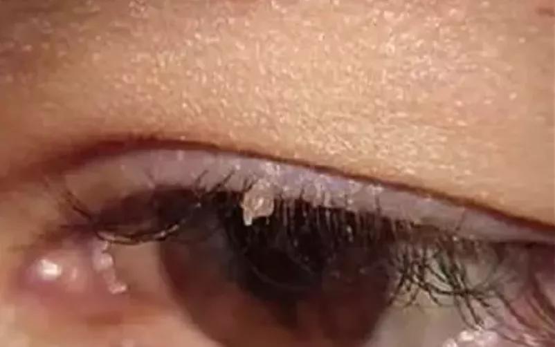 脸上长了像黑痣一样的东西,脸上长了像痘痘的东西是啥