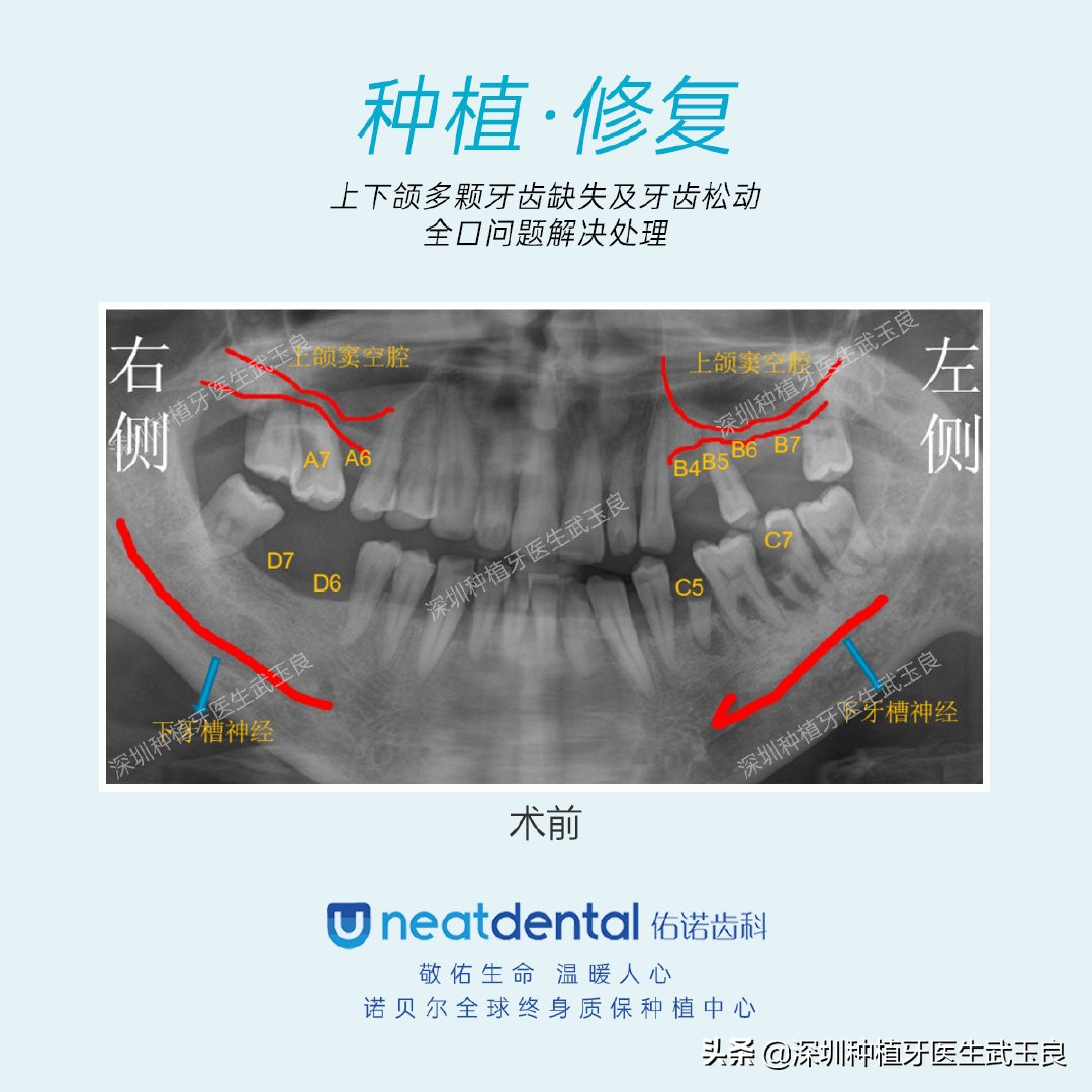 多颗牙齿缺失怎么修复全过程,多颗缺失牙修复案例