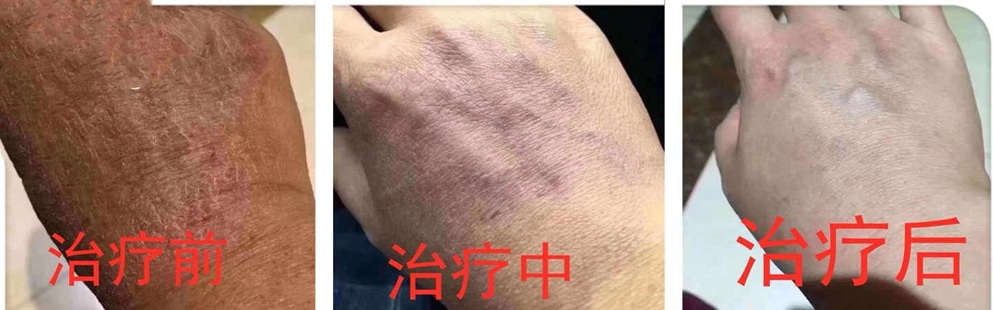 湿疹折磨人吗,皮肤科医生教你认识湿疹