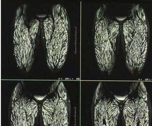 男子吃鱼生浑身肝吸虫图片,体检查出肝吸虫