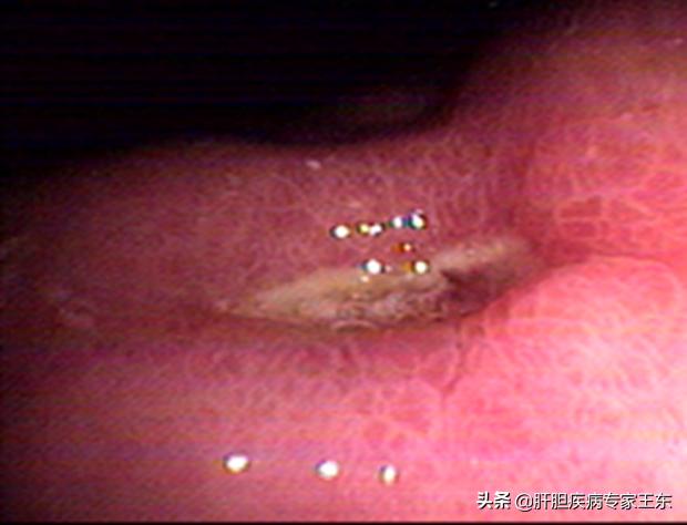 饮酒醉了吐血了怎么办,大量饮酒后吐血是怎么回事