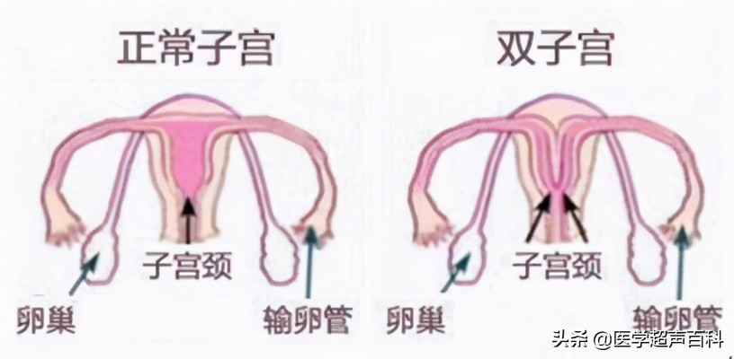 子宫发育正常是否会子宫幼稚,幼稚子宫和子宫发育不良的区别