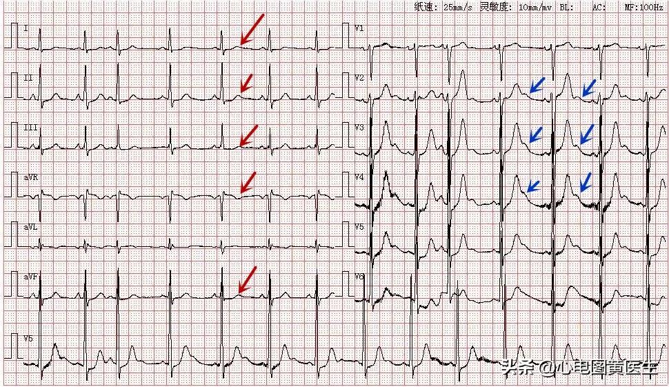 心电图出现qrs电压交替现象,心电图出现u和t波倒置