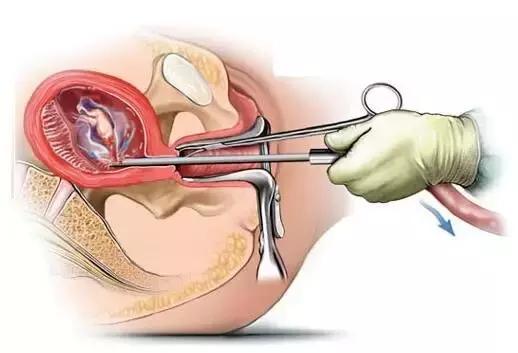 人流会有生命危险吗,人流伤身体不