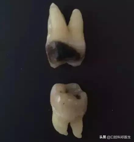 智齿很小一个自己就拔掉了,稍微晃动的智齿拔掉很快吗