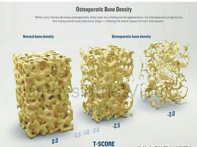 老年人骨折是什么骨折,老年人骨质疏松腰部骨折怎么办