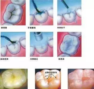 做窝沟封闭痛苦吗，价位多少？做爸妈的应该提前知道这些