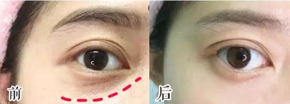 脂肪粒别用针挑教你一个土办法,脂肪粒怎么用针挑出来不疼